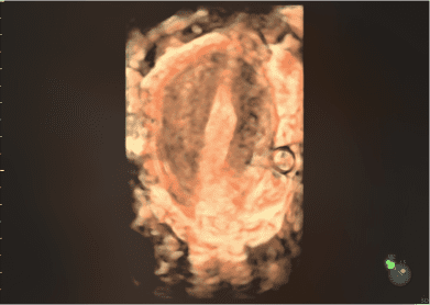 Unicornuate_uterus_with_HDlive_Studio_